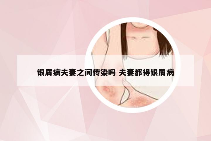 银屑病夫妻之间传染吗 夫妻都得银屑病