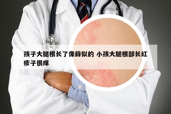 孩子大腿根长了像藓似的 小孩大腿根部长红疹子很痒