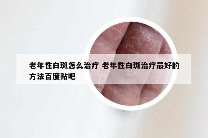 老年性白斑怎么治疗 老年性白斑治疗最好的方法百度贴吧