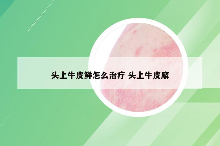 头上牛皮鲜怎么治疗 头上牛皮廨