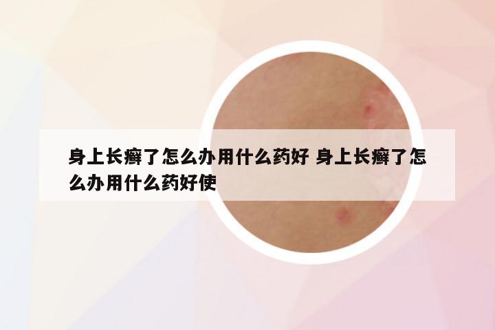 身上长癣了怎么办用什么药好 身上长癣了怎么办用什么药好使