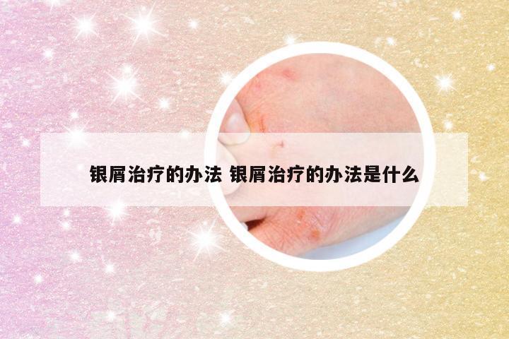 银屑治疗的办法 银屑治疗的办法是什么