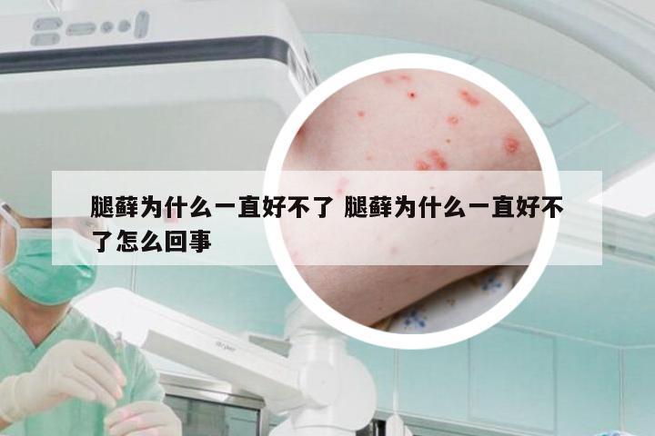 腿藓为什么一直好不了 腿藓为什么一直好不了怎么回事