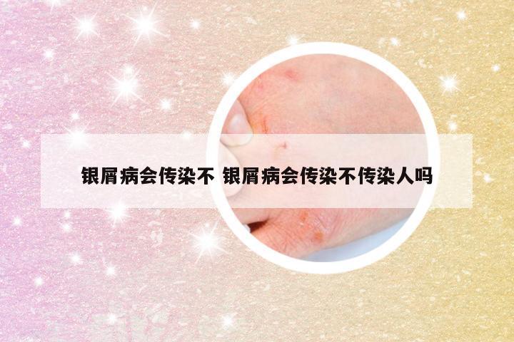 银屑病会传染不 银屑病会传染不传染人吗