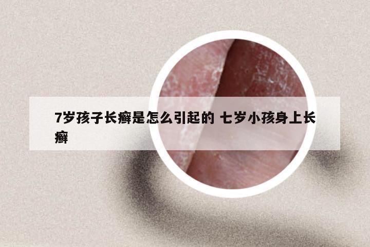 7岁孩子长癣是怎么引起的 七岁小孩身上长癣