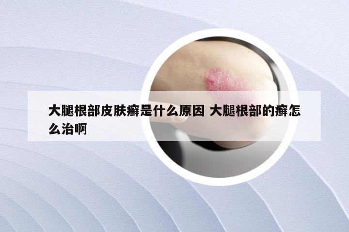 大腿根部皮肤癣是什么原因 大腿根部的癣怎么治啊