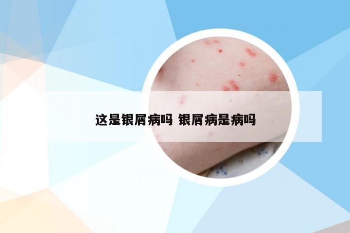 这是银屑病吗 银屑病是病吗