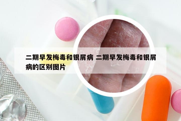 二期早发梅毒和银屑病 二期早发梅毒和银屑病的区别图片