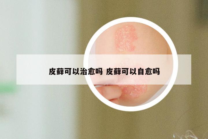 皮藓可以治愈吗 皮藓可以自愈吗