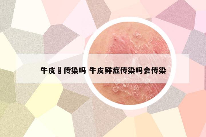 牛皮廯传染吗 牛皮鲜症传染吗会传染