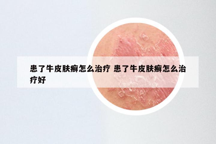 患了牛皮肤癣怎么治疗 患了牛皮肤癣怎么治疗好