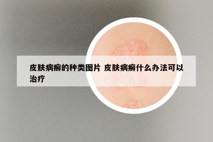 皮肤病癣的种类图片 皮肤病癣什么办法可以治疗