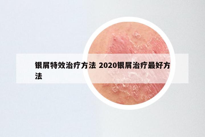 银屑特效治疗方法 2020银屑治疗最好方法