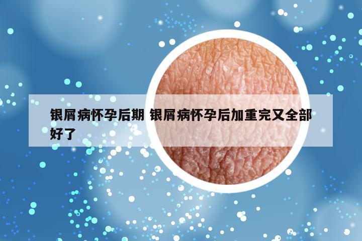 银屑病怀孕后期 银屑病怀孕后加重完又全部好了