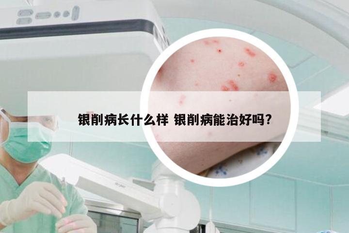 银削病长什么样 银削病能治好吗?