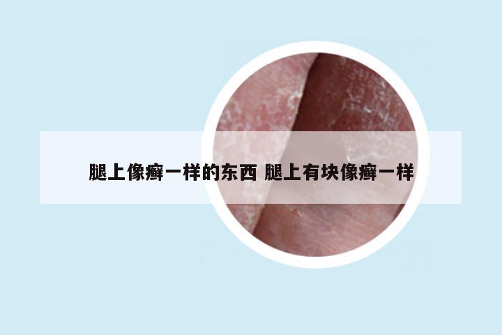 腿上像癣一样的东西 腿上有块像癣一样