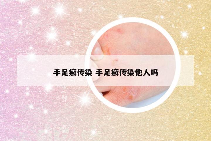 手足癣传染 手足癣传染他人吗