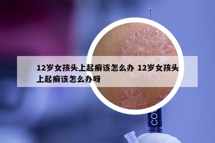 12岁女孩头上起癣该怎么办 12岁女孩头上起癣该怎么办呀