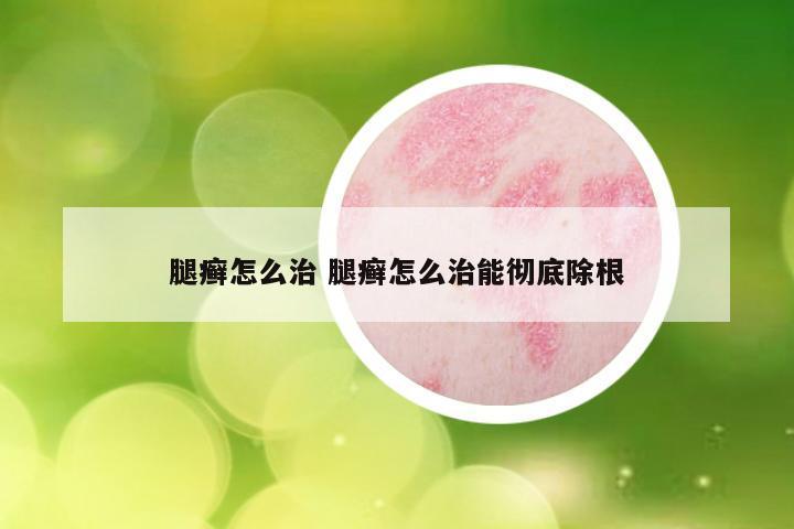 腿癣怎么治 腿癣怎么治能彻底除根