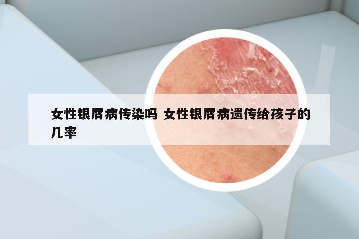 女性银屑病传染吗 女性银屑病遗传给孩子的几率