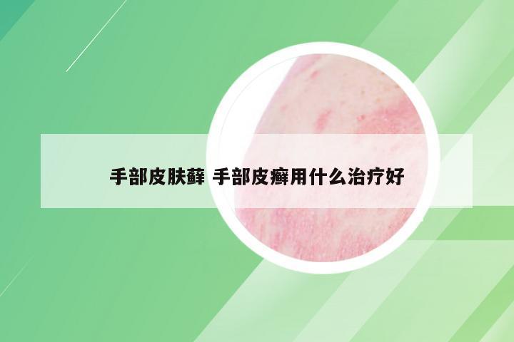 手部皮肤藓 手部皮癣用什么治疗好