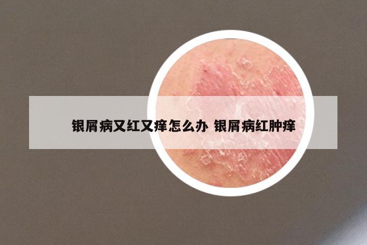 银屑病又红又痒怎么办 银屑病红肿痒