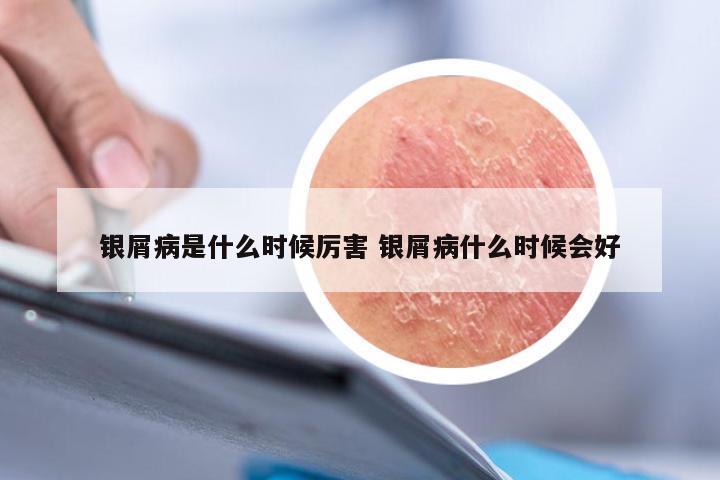 银屑病是什么时候厉害 银屑病什么时候会好