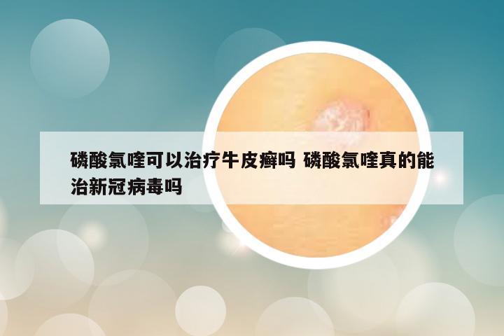 磷酸氯喹可以治疗牛皮癣吗 磷酸氯喹真的能治新冠病毒吗