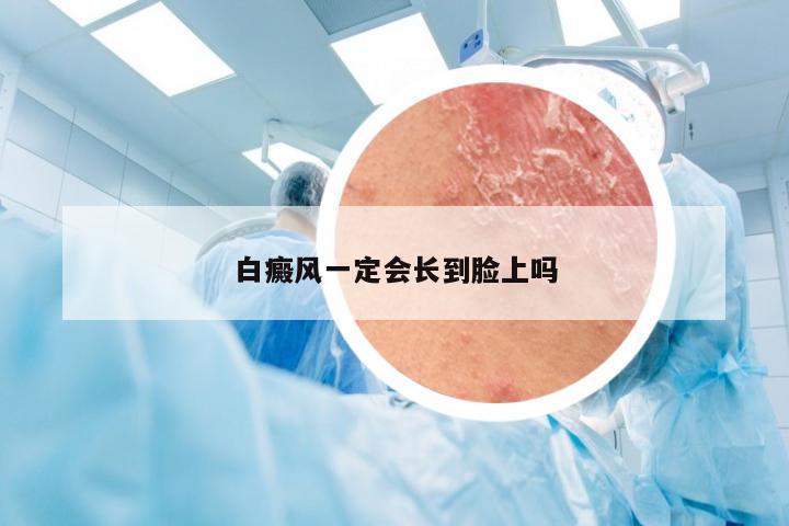 白癜风一定会长到脸上吗