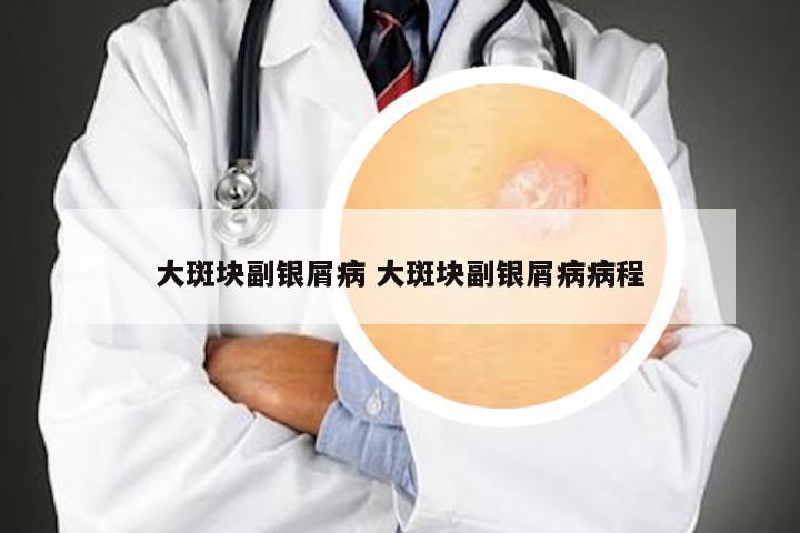 大斑块副银屑病 大斑块副银屑病病程