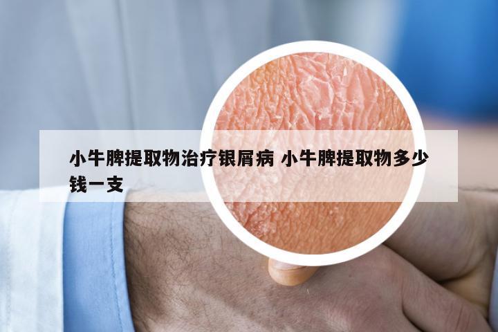 小牛脾提取物治疗银屑病 小牛脾提取物多少钱一支