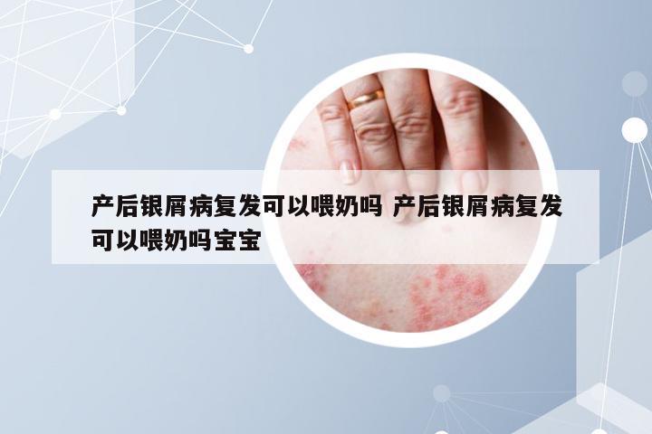 产后银屑病复发可以喂奶吗 产后银屑病复发可以喂奶吗宝宝