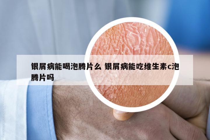 银屑病能喝泡腾片么 银屑病能吃维生素c泡腾片吗