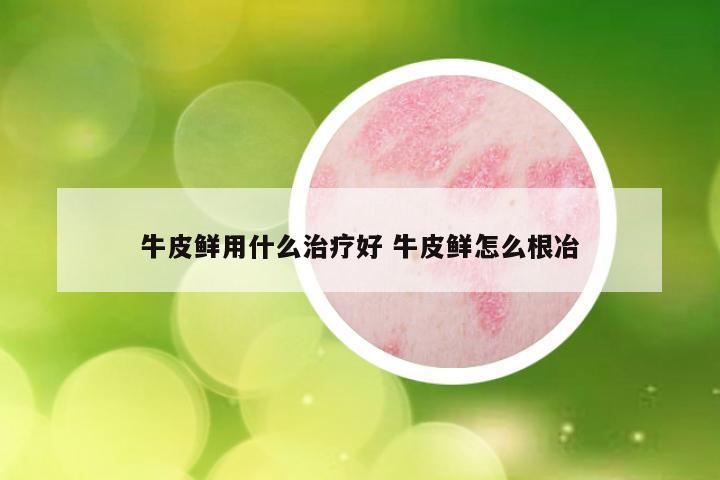 牛皮鲜用什么治疗好 牛皮鲜怎么根冶