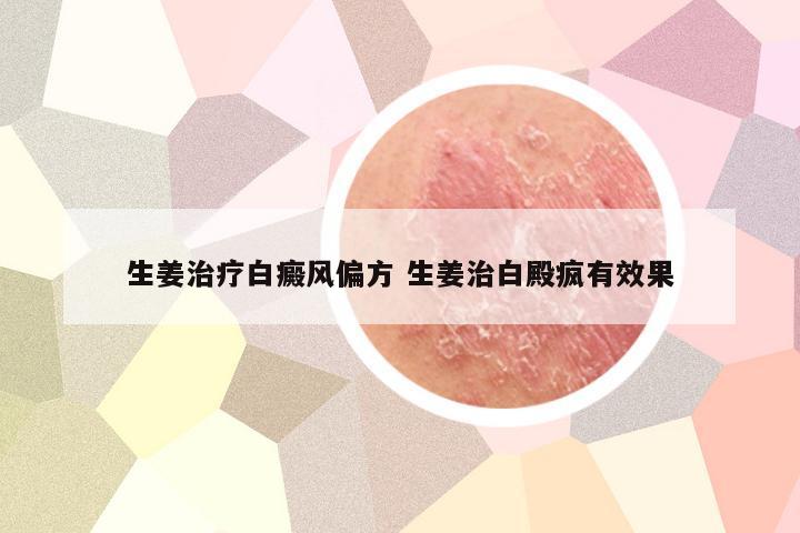 生姜治疗白癜风偏方 生姜治白殿疯有效果