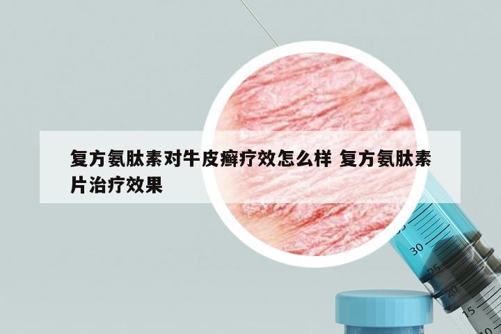 复方氨肽素对牛皮癣疗效怎么样 复方氨肽素片治疗效果