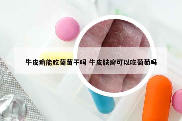 牛皮癣能吃葡萄干吗 牛皮肤癣可以吃葡萄吗