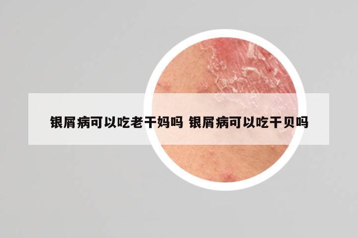 银屑病可以吃老干妈吗 银屑病可以吃干贝吗