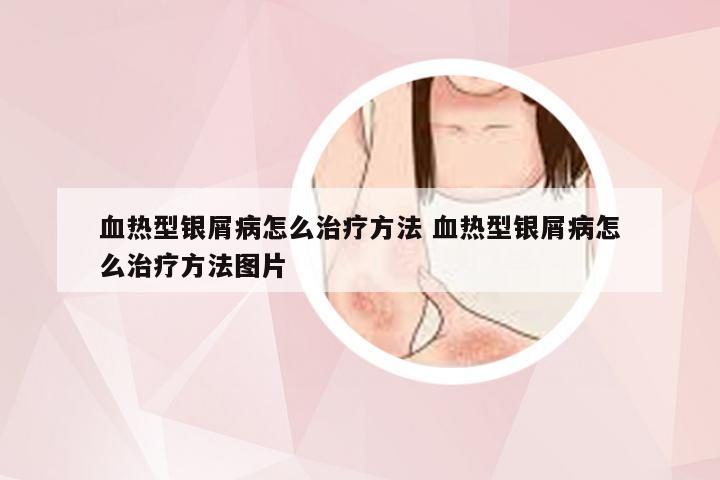 血热型银屑病怎么治疗方法 血热型银屑病怎么治疗方法图片