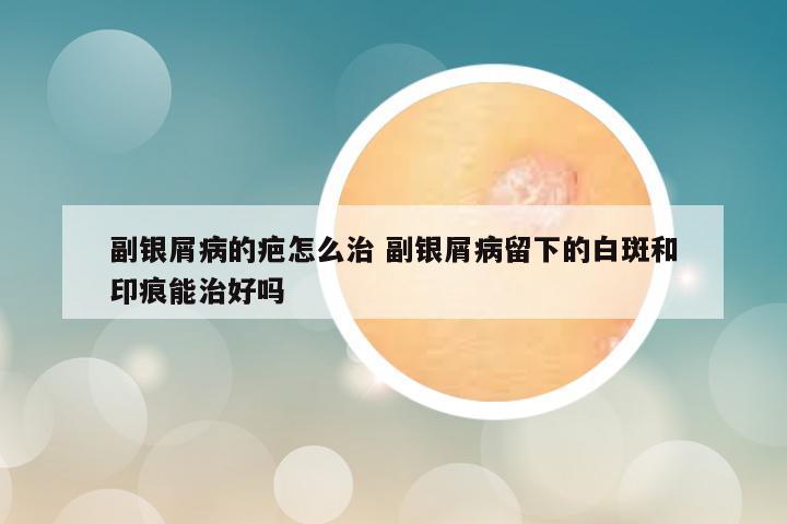 副银屑病的疤怎么治 副银屑病留下的白斑和印痕能治好吗