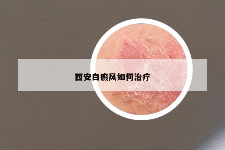 西安白癜风如何治疗