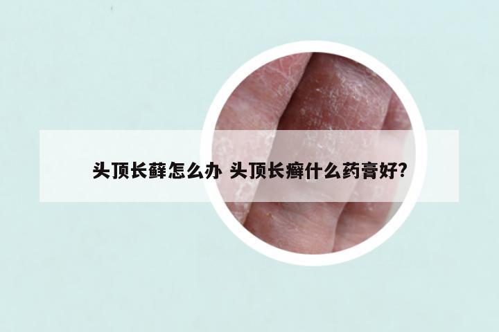 头顶长藓怎么办 头顶长癣什么药膏好?