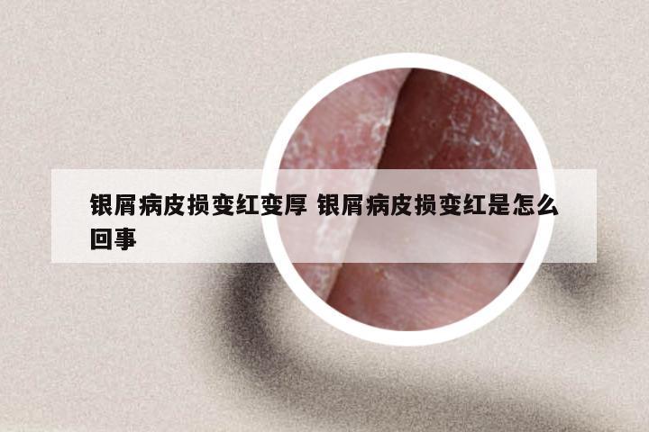 银屑病皮损变红变厚 银屑病皮损变红是怎么回事