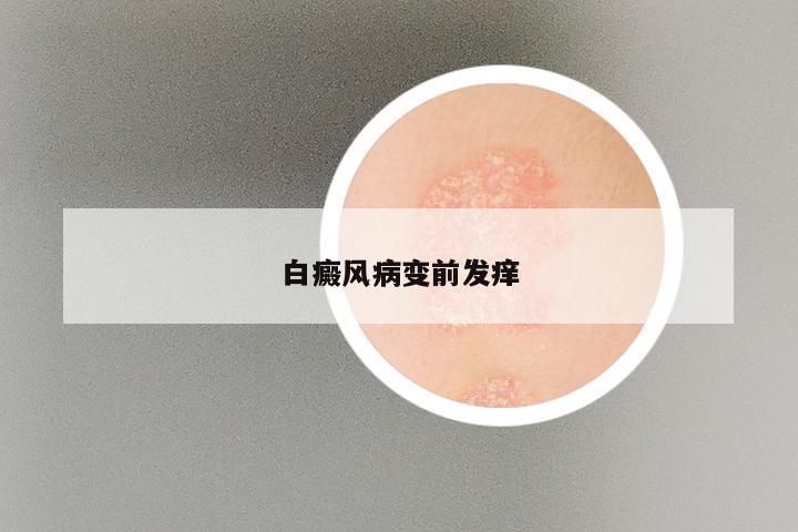 白癜风病变前发痒