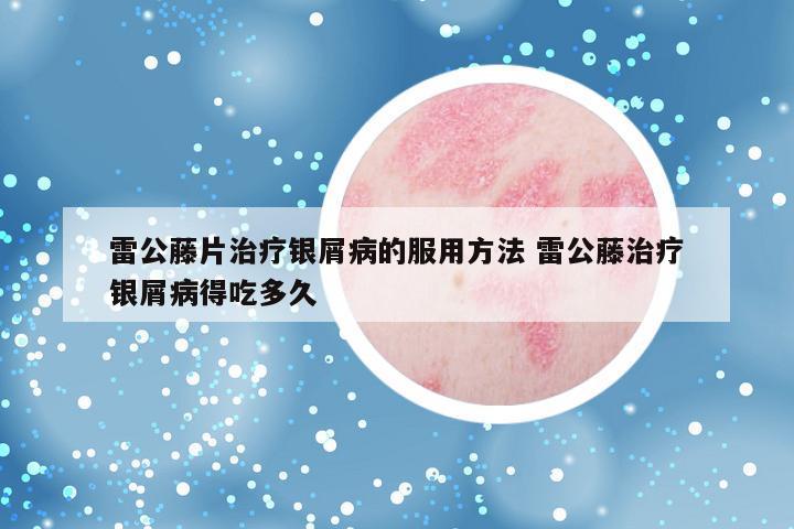 雷公藤片治疗银屑病的服用方法 雷公藤治疗银屑病得吃多久