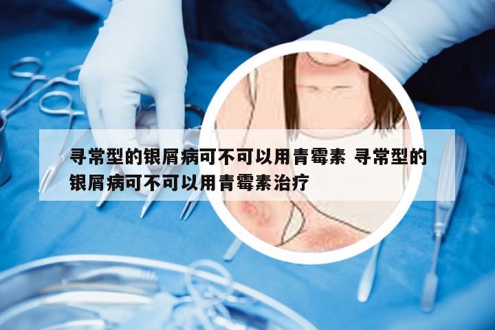 寻常型的银屑病可不可以用青霉素 寻常型的银屑病可不可以用青霉素治疗