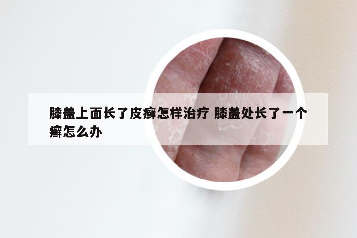 膝盖上面长了皮癣怎样治疗 膝盖处长了一个癣怎么办