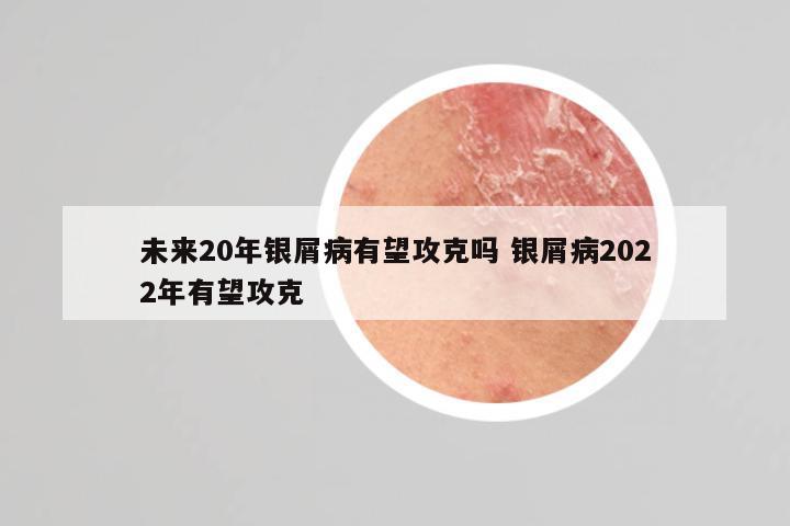 未来20年银屑病有望攻克吗 银屑病2022年有望攻克