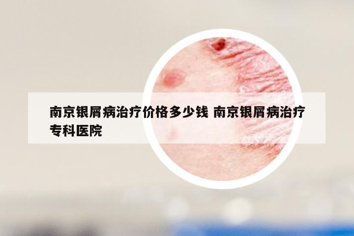 南京银屑病治疗价格多少钱 南京银屑病治疗专科医院