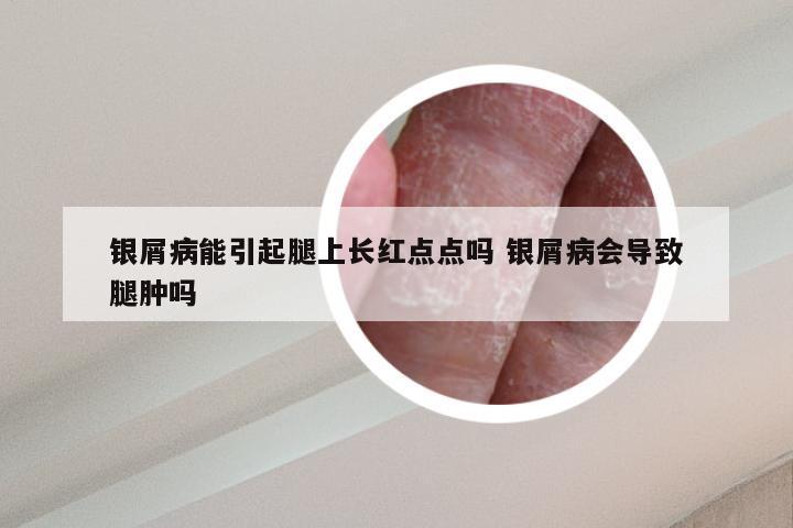 银屑病能引起腿上长红点点吗 银屑病会导致腿肿吗